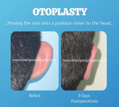 Slider image (5) Dr. Siripong Plastic Surgery in Thailand